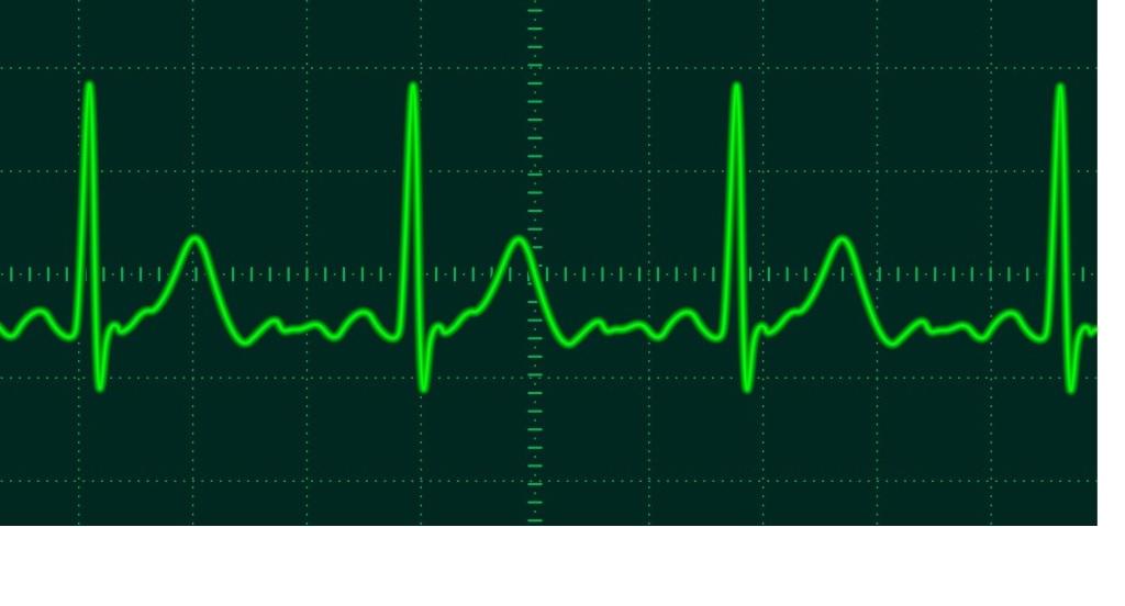 ECG